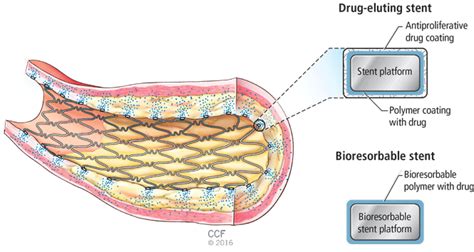 Bioresorbable stents: The future of interventional cardiology? | Cleveland Clinic Journal of ...