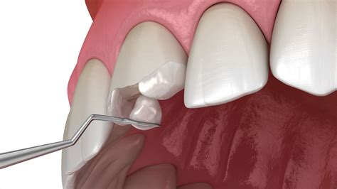 Can Broken Teeth Cause Dental Problems? - A Dental Place