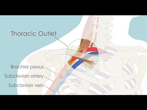 The thoracic outlet is the ring formed by the top ribs, just below the collarbone. Thoracic ...