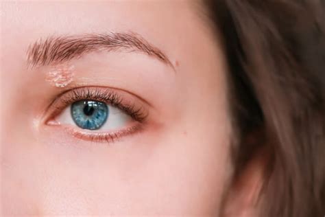 What Is Eyelid Dermatitis (Eyelid Eczema)?