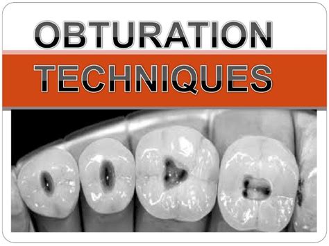 (PPT) Obturation techniques - DOKUMEN.TIPS