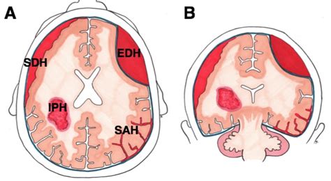 Subarachnoid Haemorrhage - Clinical Features - Management - TeachMeSurgery