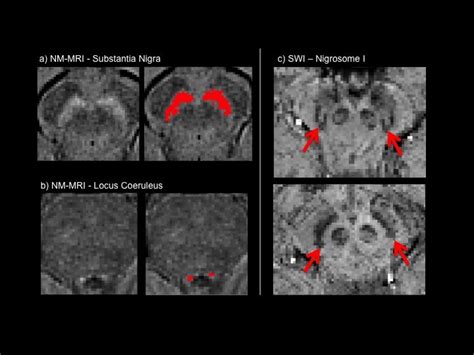 Novel sequences: Neuromelanin-sensitive (NM-MRI, left) and ...