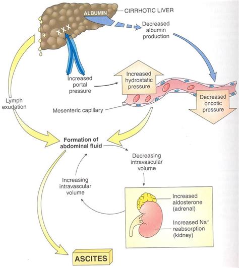 Ascites Process | Medical surgical nursing, Nursing study, Icu nursing