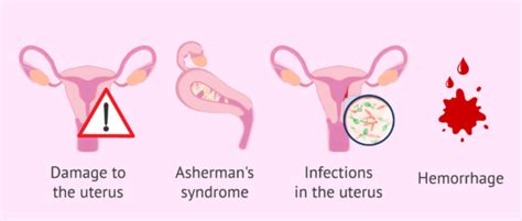 Uterine curettage - procedure, recovery and complications