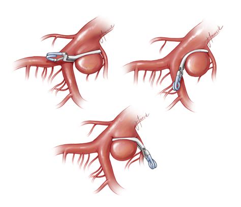 Permanent Clip Application | The Neurosurgical Atlas, by Aaron Cohen-Gadol, M.D.