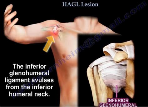 Humeral Avulsion of Glenohumeral Ligament(HAGL) — OrthopaedicPrinciples.com