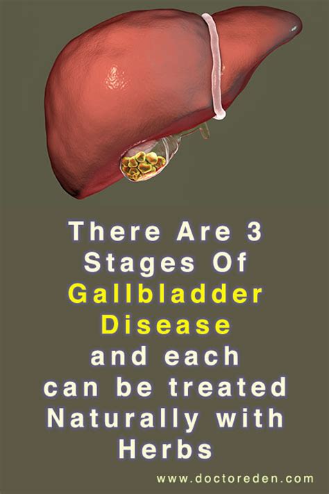 Stages Of Gallbladder Disease And How To Avoid It – Remove Gallstones ...