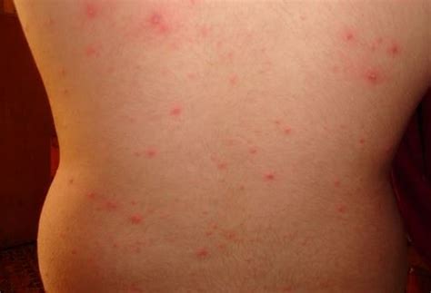 Maculopapular Rash - Pictures, Causes, Treatment, Definition, Signs