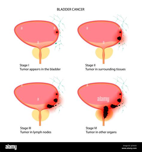 Bladder cancer stages, illustration Stock Photo - Alamy