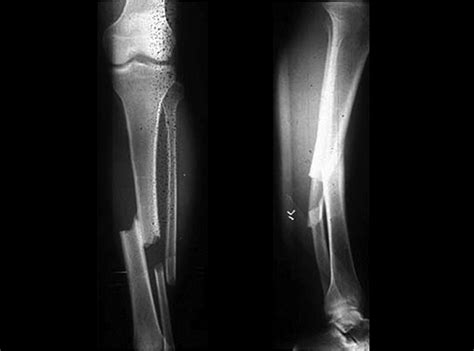 Tibia Shaft Fractures - Trauma - Orthobullets.com