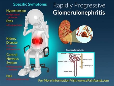 Glomerulonephritis