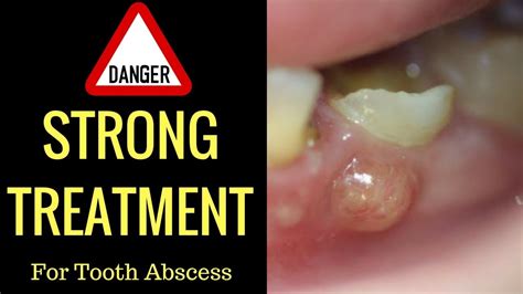 Tooth Abscess Pain