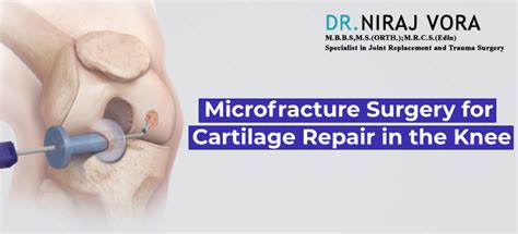 Microfracture Surgery for Cartilage Repair in the Knee