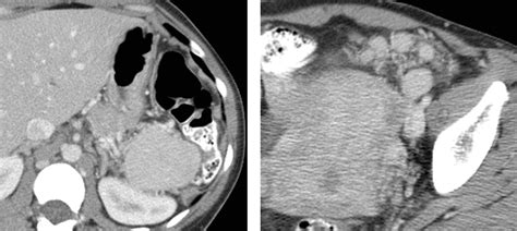 Spleen | Radiology Key