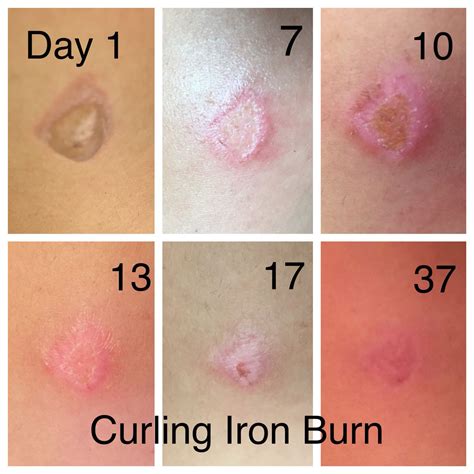 Healing Process for Second Degree Burn from Curling Iron