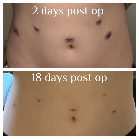 Scar progression : r/hysterectomy