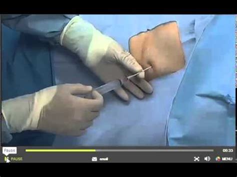 PleurX catheter placment - YouTube