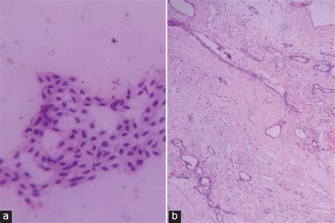 (a) Mesenchymal hamartoma cytology 400 × MGG. (b) Mesenchymal hamartoma... | Download Scientific ...