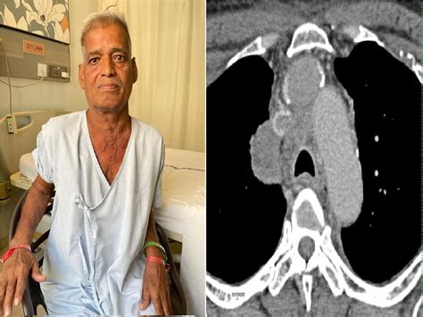 Stage-4 lung cancer patients may develop superior vena cava syndrome ...