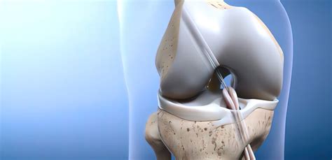 Knee Ligament Surgery – Trinay Orthopedic