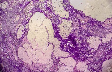 Ovarian Cyst, Light Micrograph, Photo Under Microscope Stock Image - Image of women, stain ...