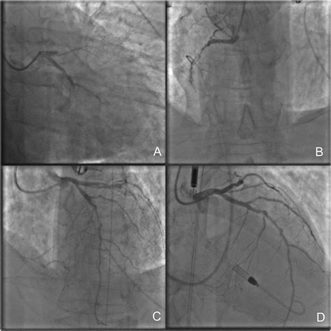 Impella 5.0 supported oncological surgery as bridge to LVAD - Montisci - 2021 - ESC Heart ...