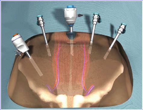 The trocar placement for right-sided Boari flap ureteral... | Download Scientific Diagram