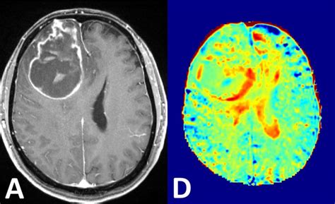 MRI contrast agents: Aiming to work without radioactivity • healthcare-in-europe.com