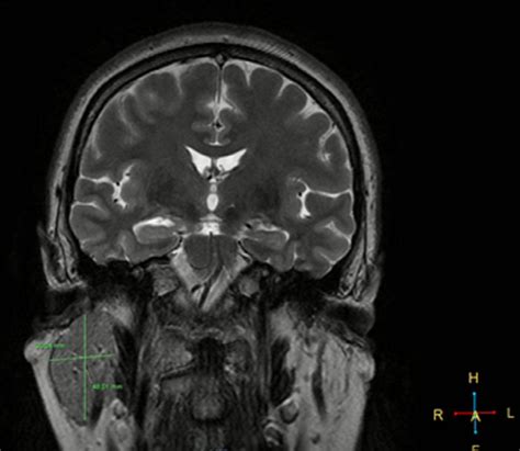 -Coronal T2 MRI revealed absence of left parotid gland and presence of... | Download Scientific ...