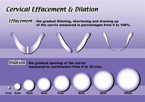 PIC/Diagram of dilation and cervical effecement | Dilations, Dilation ...