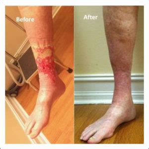 Venous Ulcer Treatment in Hollywood, FL - Minars Dermatology