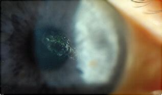 Recurrent Corneal Erosions — Moyes Eye Center