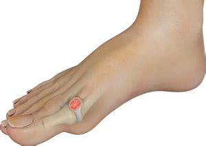 Cheilectomy Cockeysville | Ankle Arthritis Baltimore | Hallux Rigidus Towson MD