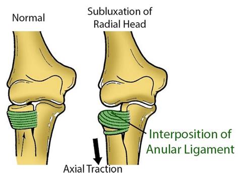 Nursemaid's Elbow - Pediatrics | Pediatrics, Subluxation, Elbow