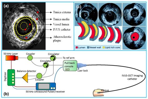 Sensors | Free Full-Text | Recent Advances in Transducers for Intravascular Ultrasound (IVUS ...