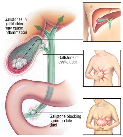 How Long Does A Gallbladder Attack Last? (CAUSES & TREATMENT)