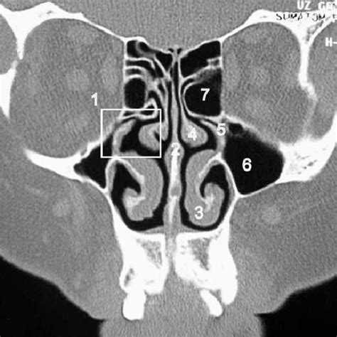 Coronal CT scan of nasal cavity at the osteomeatal complex. (1)... | Download Scientific Diagram