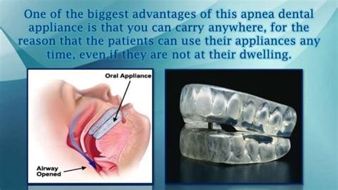 Dental Sleep Apnea Appliance