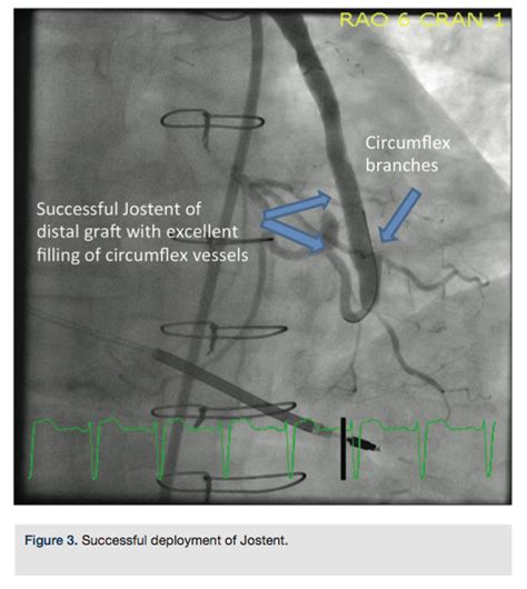 SVG to Circumflex Stenting with Significant Distal and Proximal Disease: A Complex Case ...