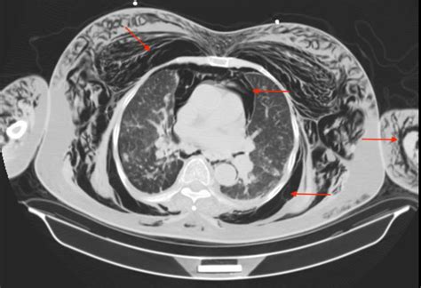 Cureus | A Case of Pneumomediastinum and Pneumoperitoneum with Concurrent Massive Subcutaneous ...