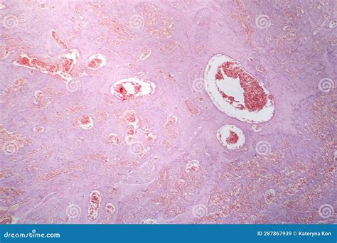 Capillary Hemangioma, Light Micrograph Stock Image - Image of pathology ...