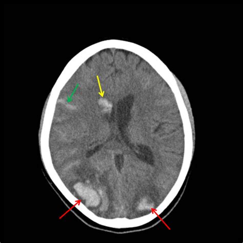 Non-Traumatic Intracranial (Intracerebral) Hemorrhage – Differential Diagnosis | RADIOLOGYPICS.COM