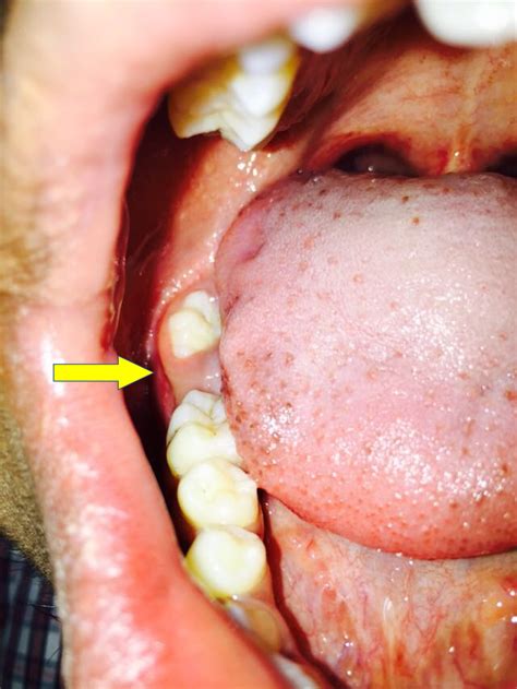 Cureus | Surgical Access to a Complex Composite Odontoma via Sagittal Split Osteotomy of the ...