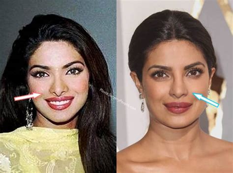 Priyanka Chopra Lip Job