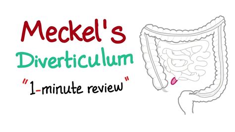 Meckel's Diverticulum (1-minute review) - YouTube