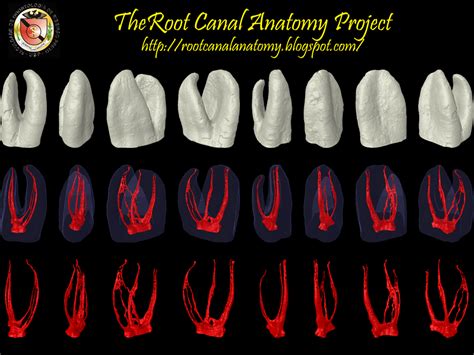 The Root Canal Anatomy Project: Middle Mesial Canal: Maxillary First Molar