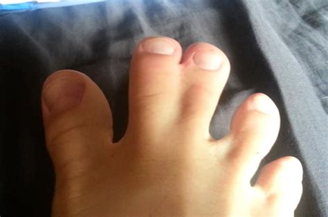 Webbed Toes - Causes, Diagnosis, Surgery and Pictures