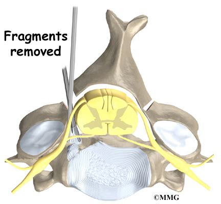 Cervical Laminectomy | eOrthopod.com