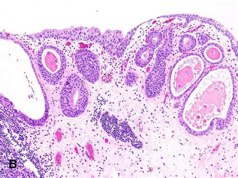 American Urological Association - Cystitis Cystica